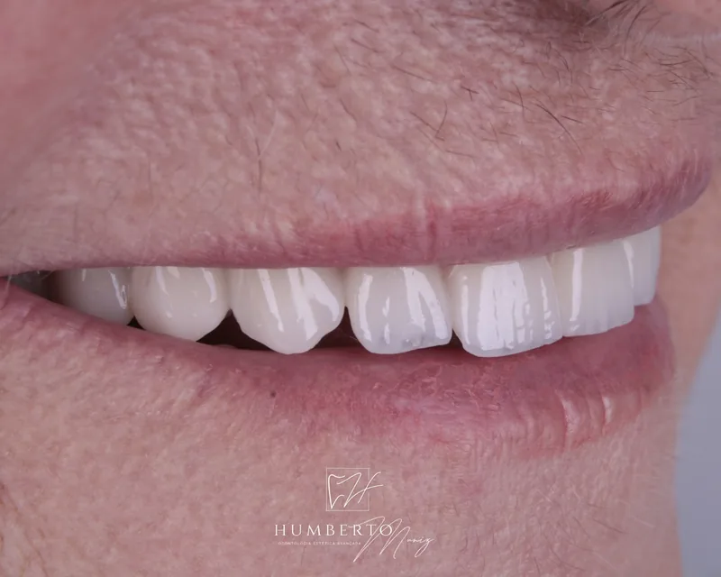 Implantes Dentários