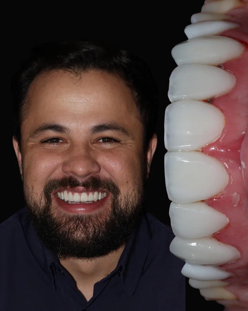 Lentes de Contato Dental